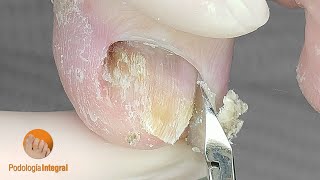 Toenail cleaning with smooth finish for the patients comfort and prevent detachments due to hooking [upl. by Dorren820]