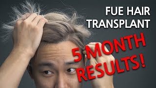 Hair Transplant in KOREA Part Two 5 Month Results Update [upl. by Race]