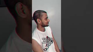 Round 2 hell fame Mehtab’s Hair Transplant Result r2h 5second youtuber hair [upl. by Ketti35]