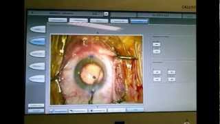 CALLISTO Eye system  Chirurgie de la cataracte Dr Coullet Montpellier [upl. by Buchbinder]