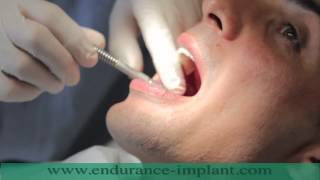 refaire toutes ses dents implant dentaire [upl. by Rebeh]