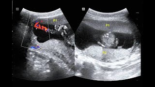 usg velamentous cord insertion in twin pregnancy [upl. by Leumek312]