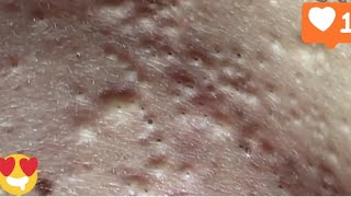 The Back Is Full Of Blackheads pimple blackheadremoval acne removal [upl. by Notlrak]