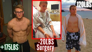 How I Lost 20lbs in 2 Weeks Nissen Fundoplication Surgery [upl. by Possing]