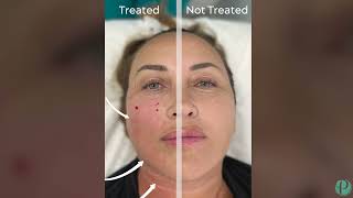 Non surgical face lift  Morpheus8 Face Contouring Before And After [upl. by Jaquenette]