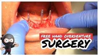 Freehand Overdenture Surgery How to lineup your angles without a guide [upl. by Ainessej727]