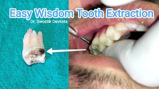 🇳🇵Wisdom Tooth Extraction under 30 SecondsEasy Removal Local Anesthesia Dental Clinic in Kathmandu [upl. by Holtz]