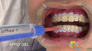 InOffice Teeth Whitening 1 round out of 3 [upl. by Norina]