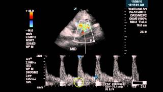 Duplex Examination of a Renal Transplant  Case Study [upl. by Assyle]