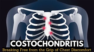 Costochondritis Breaking Free from the Grip of Chest Discomfort [upl. by Arehc261]