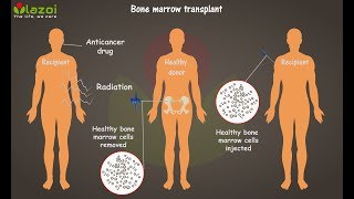 What is Bone Marrow Transplant  Complete guide about bone marrow transplantation lazoicom [upl. by Summer]