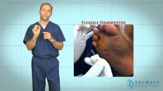 New Hammertoe Correction Procedure Performed in the Office [upl. by Nero]