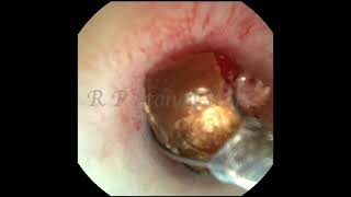 Kidney Stone Removal with RIRS Technology [upl. by Anik764]