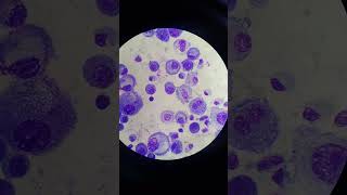 Mesothelial Cells in Pleural Fluid  Body Fluid  Fluids Giemsa Stain [upl. by Nadirehs]