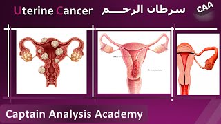 E4 Understanding Endometrial Cancer Uterine cancer سرطان الرحم اسبابة وطرق تشخيصة و علاجه [upl. by Nylirad]