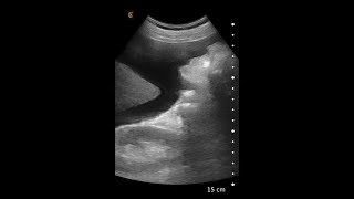 Ascites – Ultrasound Image Interpretation [upl. by Quartis]