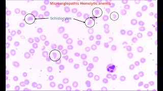 Microangiopathic hemolytic anemia [upl. by Slen660]