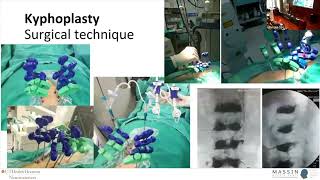 Vertebroplasty or Kyphoplasty  MASSIN Congress Day 2  Session 6 Talk 3 [upl. by Macdermot]