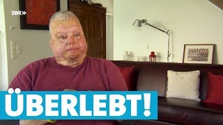 Bernhard überlebt FlugzeugExplosion trotz schwerer Verbrennungen [upl. by Llirrem]