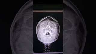 PNS XRAYparanasal sinusPNS Headdoctor Head anatomy nasal septum is deviated to right side [upl. by Dionysus]