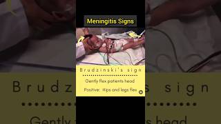 Meningitis Signs Kernigs amp Brudzinskis sign neurology shorts fmge neetpg viralvideo [upl. by Yrolam485]