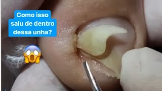 COMO ISSO ESTAVA DENTRO DESSE DEDO ingrowntoenail [upl. by Yedoc]