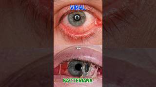 conjuntivitis viral vs Bacteriana salud conjuntivitis diferencias viral bacteriana [upl. by Alarice]