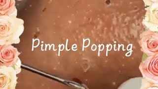 Pimple amp Blackheads Popping  10 [upl. by Eitsirk]