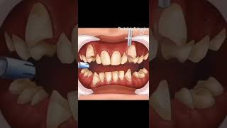 How to put on braces viralvideo dentist dentalschoollife trending orthodontist happysmile [upl. by Yendyc649]