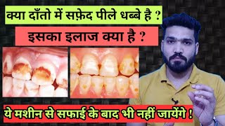 दाँतो के सफ़ेद पीले धब्बे कैसे साफ होंगे  dental fluorosis [upl. by Martina]