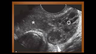 Ultrasonographic diagnosis of Pyosalpinx [upl. by Enaffit629]