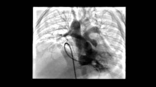 Tetralogy of Fallot RV Angiogram [upl. by Ternan]