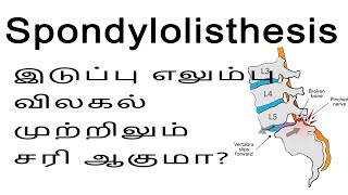 Lumbar Spine Dislocation in Tamil Listhesis  இடுப்பு எலும்பு விலகல் சரியானதா  Patient Review [upl. by Ocer133]