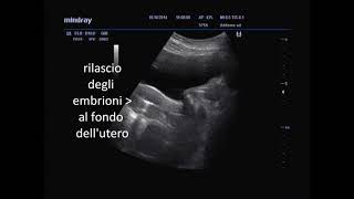 TRASFERIMENTO ECOGUIDATO DI EMBRIONI ONE DAY MEDICAL CENTER ROMA [upl. by Iman]