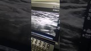 US guided genitofemoral nerve block [upl. by Evod902]