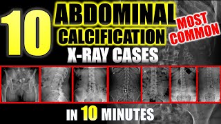 Abdominal Calcifications on XRay  10 Most Common radiology [upl. by Huberty]