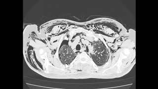 Pneumotórax pneumomediastino e enfisema subcutâneo [upl. by Sitnik]