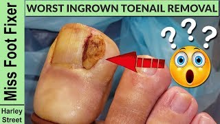 BAD INGROWN TOENAIL  ingrown toenail and impacted toenail removal By Miss Foot Fixer Marion Yau [upl. by Llewop]