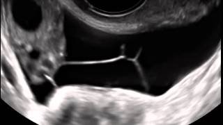 Ultrasound in Obstetrics amp Gynecology A Practical Approach  Clip 124 [upl. by Ancier134]