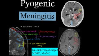 Pyogenic meningitis discussion Leptomeningeal enhancementDifferential diagnosis [upl. by Noelani]