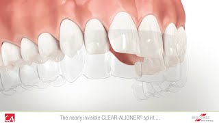 Treatment of Malocclusion Teeth with Invisible Splint [upl. by Drew]