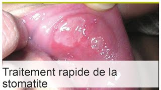 Traitement rapide et efficace de la stomatite chez les enfants avec des remèdes populaires [upl. by Salkin]