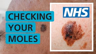 How do I check if my mole is skin cancer  NHS [upl. by Ahsitnauq207]