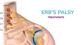 Erbs Palsy Treatment in Newborn [upl. by Mandal]