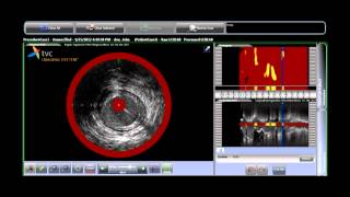 Using TVC Imaging System to Determine Treatment Strategy for STEMI [upl. by Lennie122]