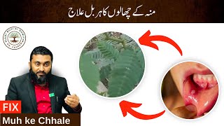 منہ کے چھالوں کا ہربل علاج  Dr Fahim Herbalist [upl. by Bolitho239]