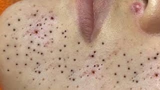 Blackhead removal  blackhead treatment  how to remove blackhead  drkynt48 [upl. by Yendic]