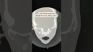 Cholesteatoma with Mastoiditis CT Temporal Bones [upl. by Dnaltroc]