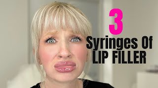 3 FULL Syringes Of Lip Filler [upl. by Noicpecnoc]