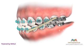 Orthodontics Treatment for Underbite or Crossbite  Rubber Bands [upl. by Ayiram469]